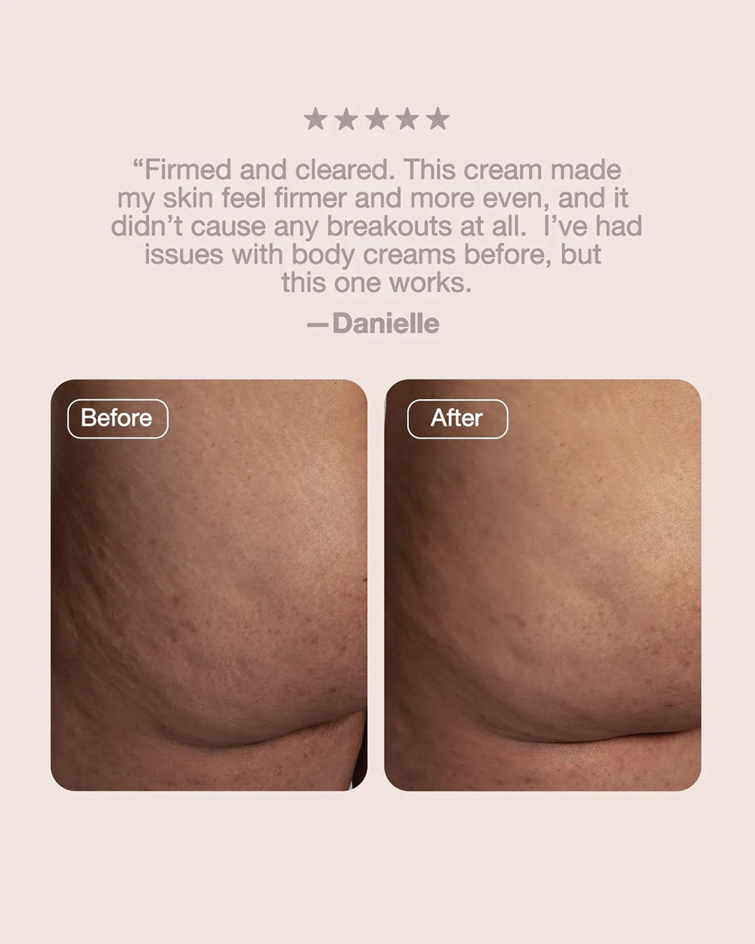 Buttface BBL Firming Cream — customer results and dermatologist-approved claim testimonial graphic